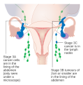 Stage 3 ovarian cancer