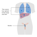 Stage 4 choriocarcinoma