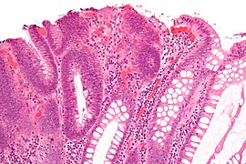 Micrograph of a tubular adenoma, the most common type of dysplastic polyp in the colon
