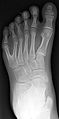 Polydactylic left foot