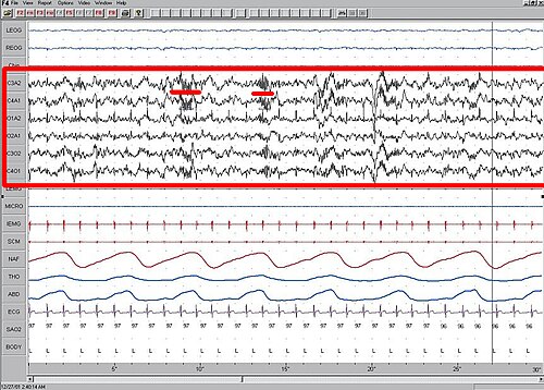 第二期睡眠，腦電圖（EEG）以紅框凸顯，睡眠紡錘波加以紅色底線。