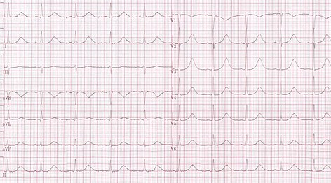 Long QT syndrome