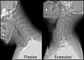 X-ray of cervical spine in flexion and extension