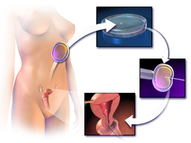 Стадии экстракорпорального оплодотворения