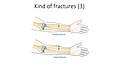 Kind of fractures - Closed fracture Open fracture