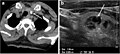 CT (L) and ultrasound (R) of thyroid colloid nodule with calcification[15][10]