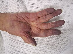 زرقة في يد مريض يعاني من نقص الأكسجين (طب الصدر، طب القلب)