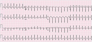 ECG of a 51-year-old female with AVNRT