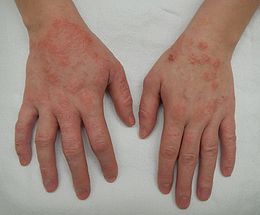 Description de l'image Dermatitis2015.jpg.