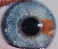 عين شخص بالغ توضّح تغاير التلوّن الجزئي حيث تظهر بقعة برتقاليّة اللّون في عينه اليمنى ذات اللّون الأزرق. ومن الجدير بالذّكر أن والدة هذا الشّخص كانت تملك نفس البقعة في عينها اليسرى ذات اللّون الأخضر