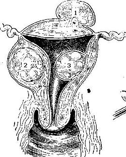 Description de l'image Fibroid.jpg.