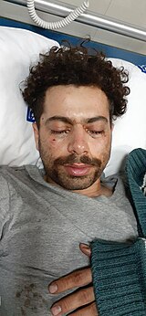 Mohammad Hossein Erfan in a hospital bed with both eyes closed, face bruised and swelling around the eyes with visible injuries from multiple pellets on his face.