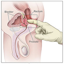 A gloved finger inserted into a man's rectum presses on the prostate
