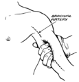 The brachial artery can be palpated midway along the medial side of the arm