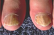 红色毛癣菌所引起的趾甲真菌病，俗稱灰甲