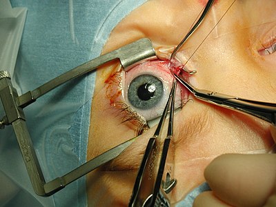 Strabismus surgery, by Bticho