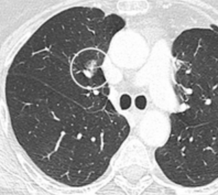 Part solid nodule.[9]