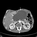 Eine weitere große Pankreaspseudocyste, die sich klinisch zunächst nicht von einem Aortenaneurysma differenzieren ließ.