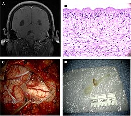 Imaging, pathology, and surgical findings of neurocysticercosis