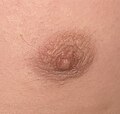 C – Chest hair around nipple of adolescent male.