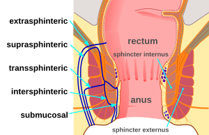 This is a modified version of the original by Armin Kübelbeck [CC BY 3.0 (http://creativecommons.org/licenses/by/3.0)], via Wikimedia Commons, https://commons.wikimedia.org/wiki/File:Piles_diffdiag_01.svg Specifically, it was made fistula-specific by removing abscess labels.