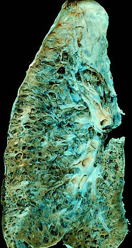 Description de l'image End-stage interstitial lung disease (honeycomb lung).jpg.