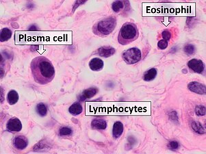 Benign chronic mixed inflammation of an inflammatory sinonasal polyp.