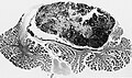 Immagine da esame microscopico di medulloblastoma.