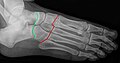 Radiographie du pied: articulation de Chopart (talo-navicualire et calcanéo-cuboïdienne) en vert et articulations de Lisfranc (tarso-métatarsiennes) en rouge.