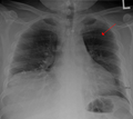 Fracture de côte sur une radiographie standard