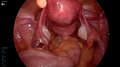 Uterus, fallopian tubes, and ovaries
