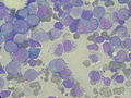 Bone marrow aspirate showing acute myeloid leukemia with Auer rods in several blasts