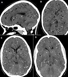 CT scan of neurocysticercosis before and after treatment