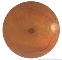 A macular Hole