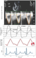 Wiggers diagram with mechanical (echo), electrical (ECG), and aortic pressure (catheter) waveforms, together with an in-ear dynamic pressure waveform measured using a novel infrasonic hemodynography technology, for a patient with severe aortic stenosis. Modified from [3]