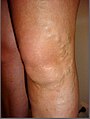 Varicose Anterior accessory saphenous vein at the knee