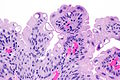 Image histologique de papillome urothélial.