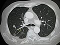 Lung metastases.