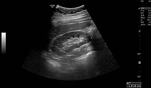 Normal adult right kidney as seen on abdominal ultrasound with a pole to pole measurement of 9.34 cm