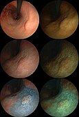 0-IIa, tub1 の早期胃癌。左列は通常光。右列はFICE。一列目は通常。二列目は酢酸染色。三列目はAIM染色。
