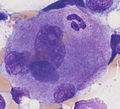 Emperipolesis: Megakaryocyte containing a segmented neutrophil, stained with a May-Grünwald Giemsa stain.