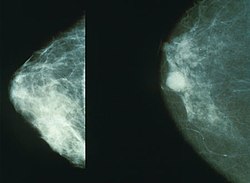 ממוגרפיה המראה שד נורמלי (שמאל) ושד עם סרטן (ימין)