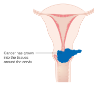 Stage IIB cervical cancer