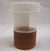 Urine from a person with rhabdomyolysis showing the characteristic brown discoloration as a result of myoglobinuria