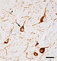 Micrograph of tauopathy (brown) in a neuronal cell body (arrow) and process (arrowhead) in the cerebral cortex of a patient with Alzheimer's disease. Bar = 25 microns (0.025mm).