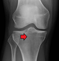 Subtle tibial plateau fracture on an AP X ray of the knee