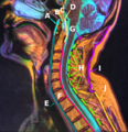 E:Anterior longitudinal ligament