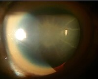 Sunflower cataract and thick KF ring of a 40-year-old male with Wilson's disease and decompensated CLD