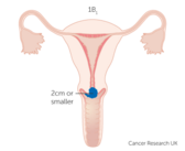 Stage IB1 cervical cancer