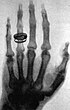 Roentgen's X-ray picture of the hand of Alfred von Kolliker